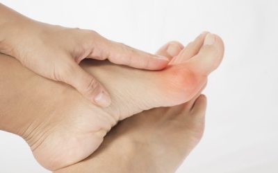 All about Foot Bunions