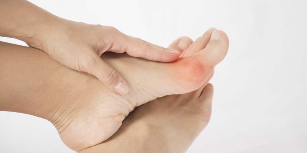 The hallux abducto-valgus (HAV, Bunions on the Feet) is a bony deviation that appears on the side of the feet.