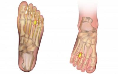 Morton’s Neuroma An Informed Look at This Podiatric Pathology