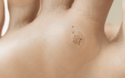 Plantar Warts Understanding, Treating, and Preventing