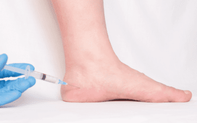 Fasciite plantaire et l’injection de cortisone : Comprendre et traiter efficacement la douleur du pied