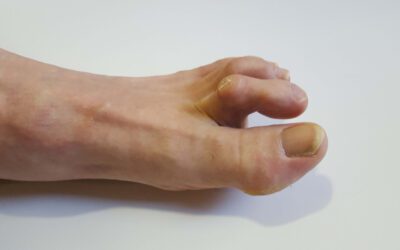 Mallet Toe and Hammer Toe An Exploration of Common Foot Pathologies
