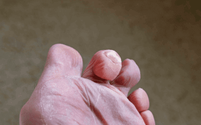 Hammer Toes: A Deep Look into This Deformity
